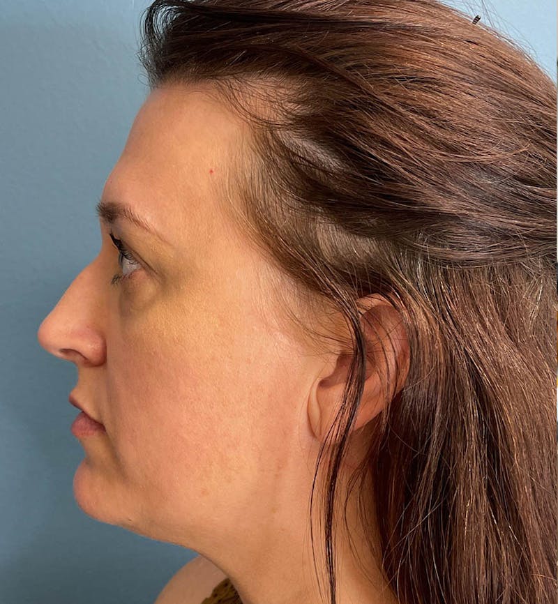 Sculptra for the Face Before & After Gallery - Patient 271715 - Image 3
