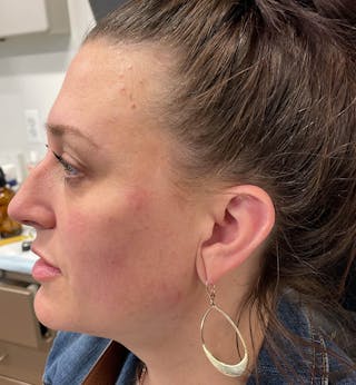 Sculptra for the Face Before & After Gallery - Patient 271715 - Image 4