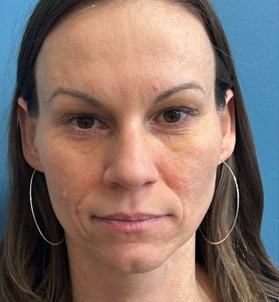 Sculptra for the Face Before & After Gallery - Patient 137254 - Image 1