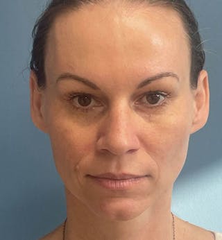 Sculptra for the Face Before & After Gallery - Patient 137254 - Image 2