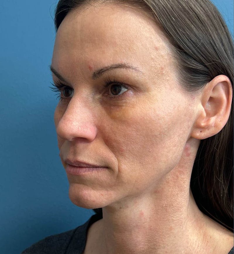 Sculptra for the Face Before & After Gallery - Patient 137254 - Image 3