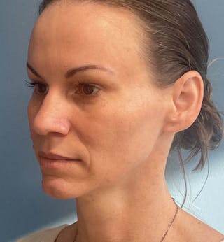 Sculptra for the Face Before & After Gallery - Patient 137254 - Image 4