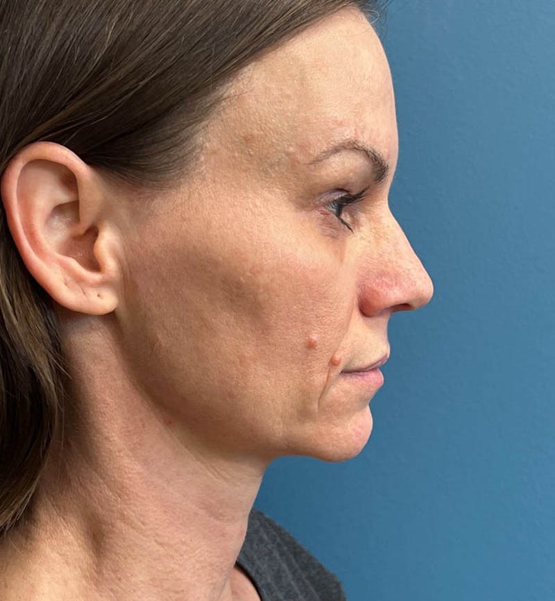Sculptra for the Face Before & After Gallery - Patient 137254 - Image 5