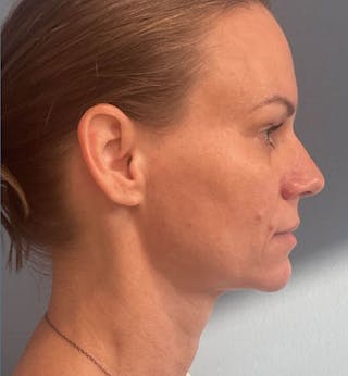 Sculptra for the Face Before & After Gallery - Patient 137254 - Image 6