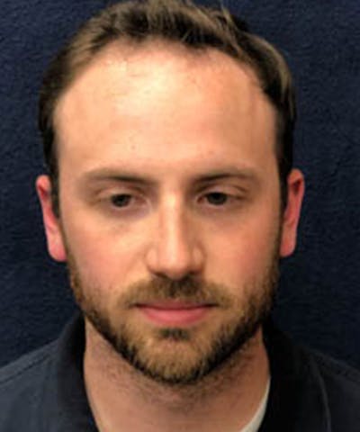 FUE Hair Restoration Before & After Gallery - Patient 141435 - Image 1
