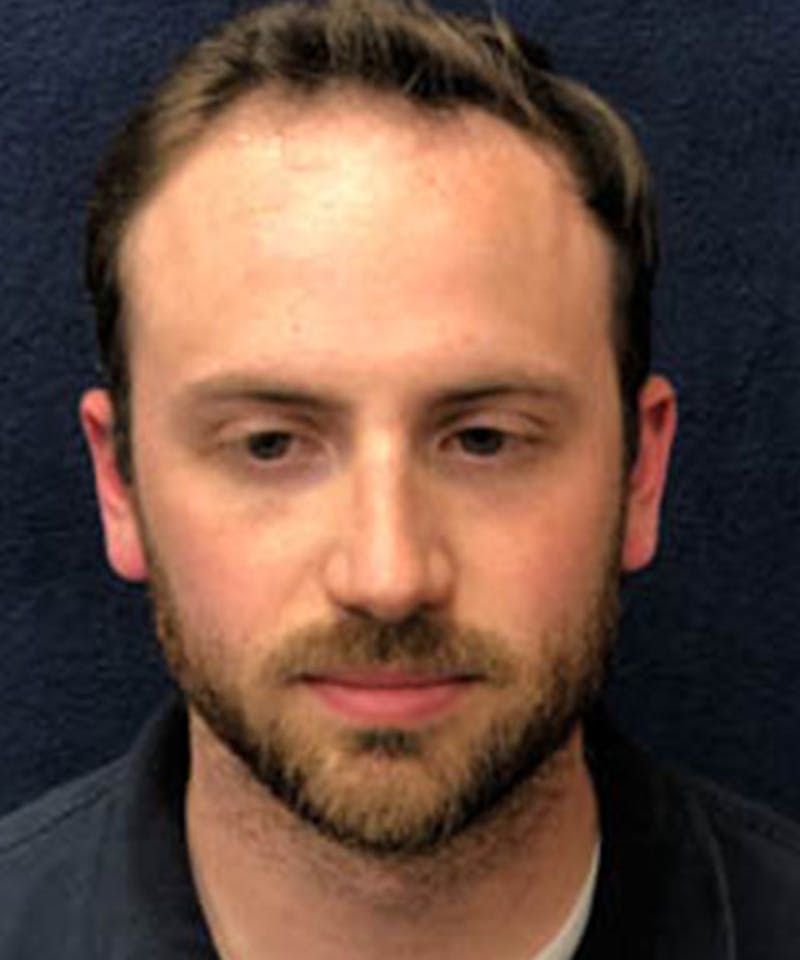 FUE Hair Restoration Before & After Gallery - Patient 141435 - Image 1