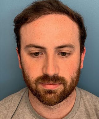 FUE Hair Restoration Before & After Gallery - Patient 141435 - Image 2