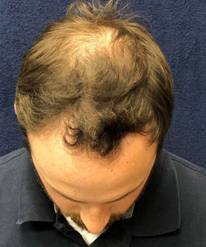 FUE Hair Restoration Before & After Gallery - Patient 141435 - Image 3