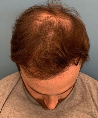 FUE Hair Restoration Before & After Gallery - Patient 141435 - Image 4