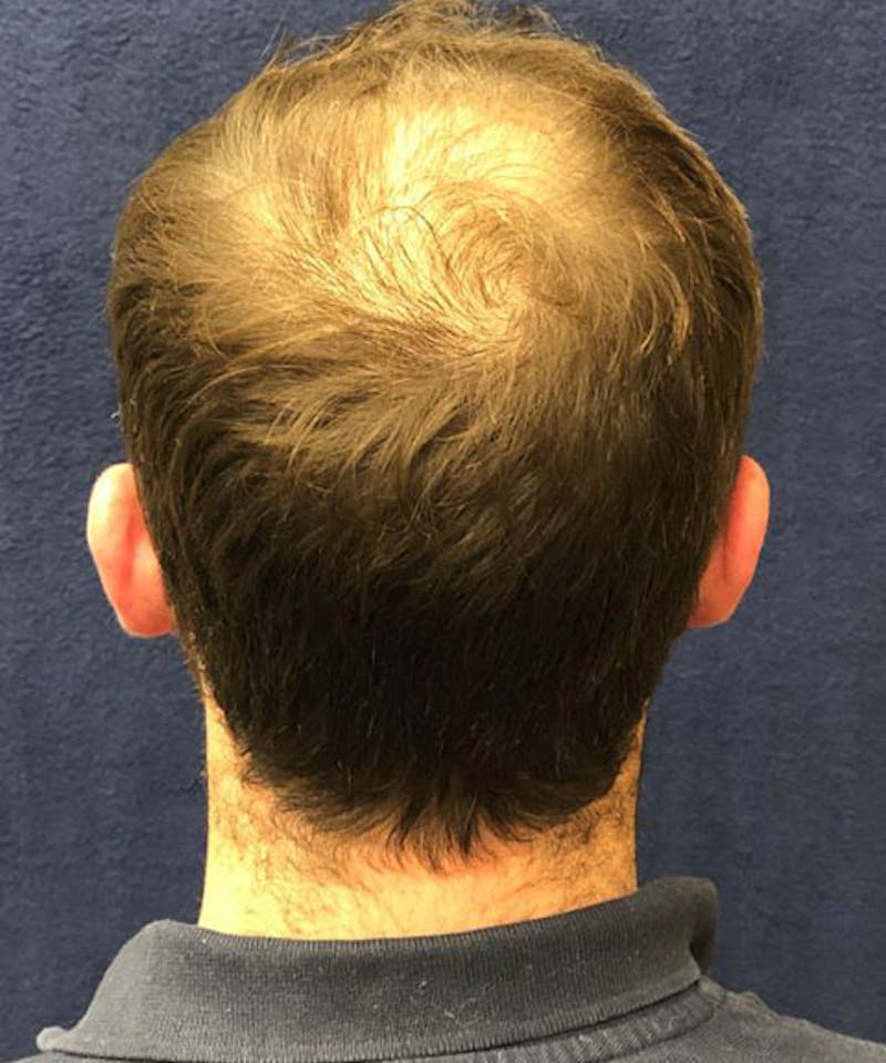 FUE Hair Restoration Before & After Gallery - Patient 141435 - Image 5