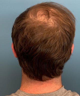 FUE Hair Restoration Before & After Gallery - Patient 141435 - Image 6