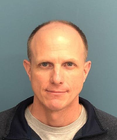 FUE Hair Restoration Before & After Gallery - Patient 408235 - Image 1