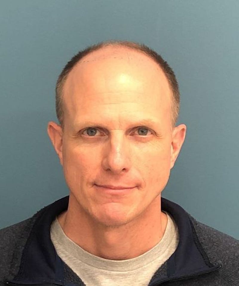 FUE Hair Restoration Before & After Gallery - Patient 408235 - Image 1