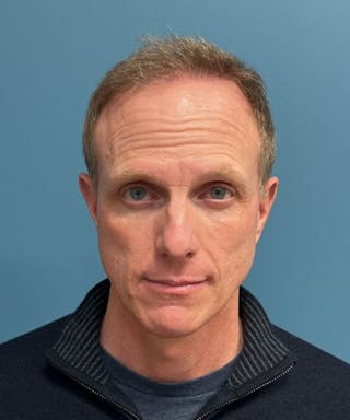 FUE Hair Restoration Before & After Gallery - Patient 408235 - Image 2