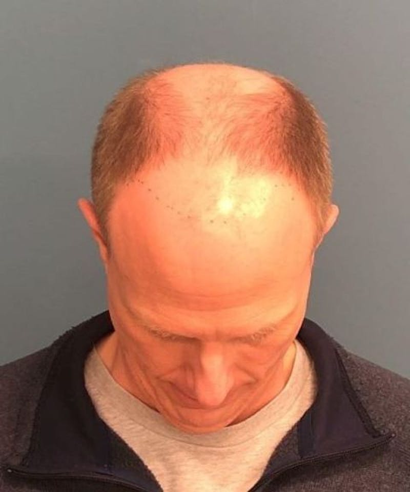 FUE Hair Restoration Before & After Gallery - Patient 408235 - Image 3