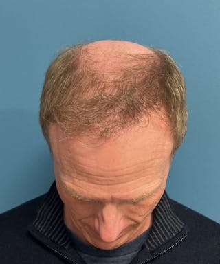 FUE Hair Restoration Before & After Gallery - Patient 408235 - Image 4