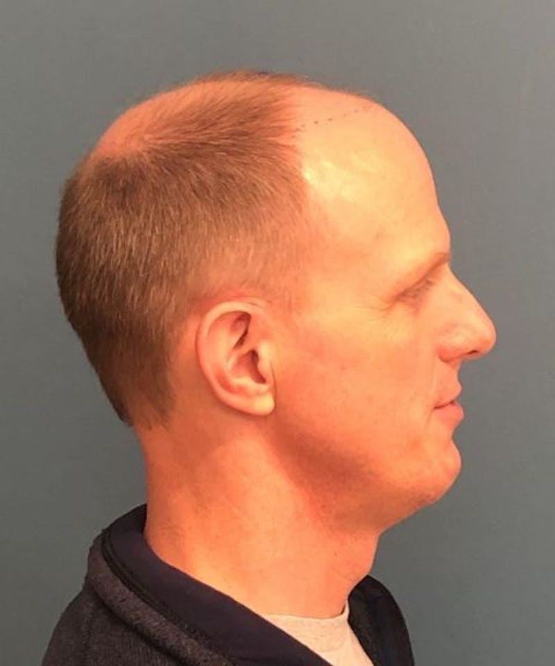 FUE Hair Restoration Before & After Gallery - Patient 408235 - Image 5