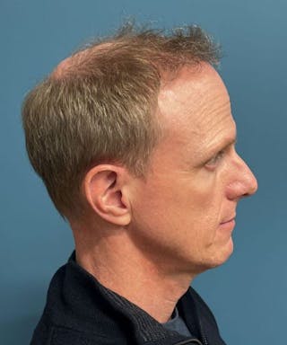 FUE Hair Restoration Before & After Gallery - Patient 408235 - Image 6