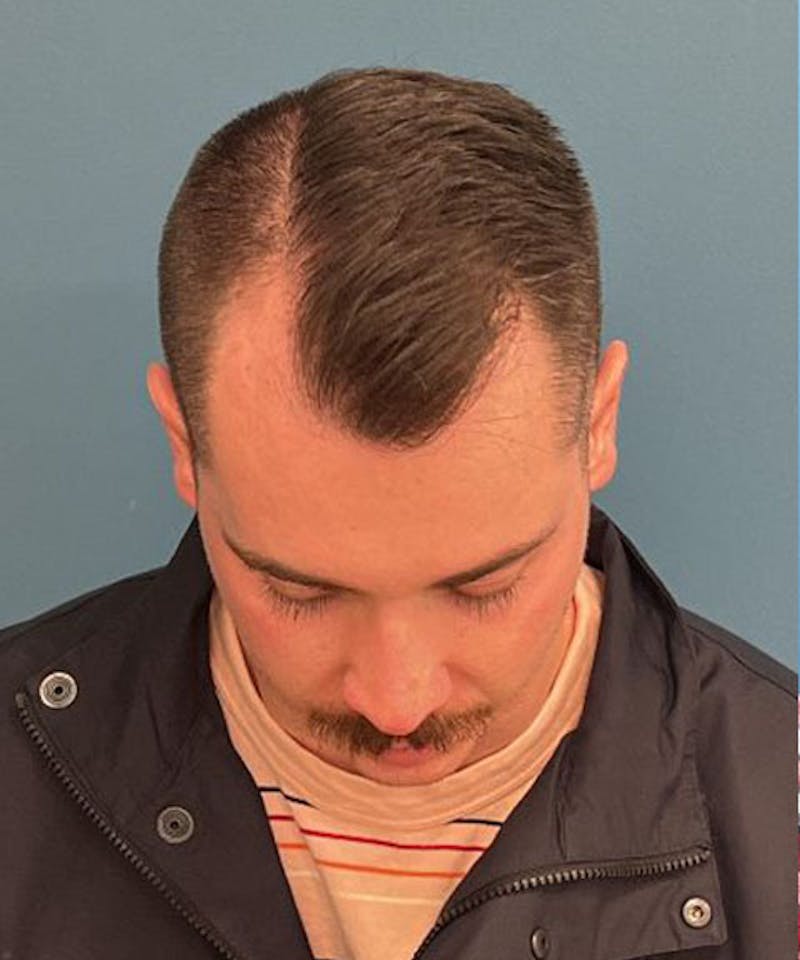 FUE Hair Restoration Before & After Gallery - Patient 208667 - Image 3