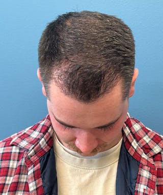FUE Hair Restoration Before & After Gallery - Patient 208667 - Image 4
