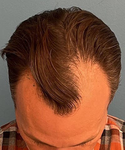 FUE Hair Restoration Before & After Gallery - Patient 412961 - Image 1