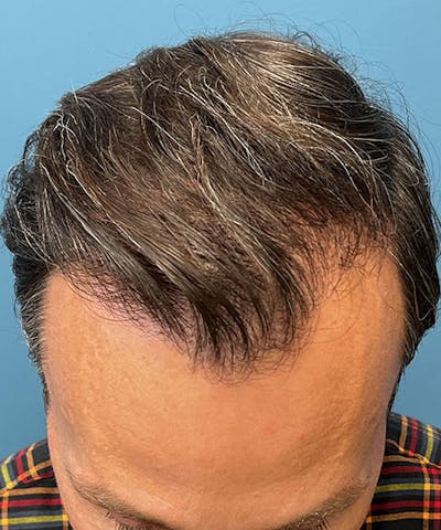 FUE Hair Restoration Before & After Gallery - Patient 412961 - Image 2