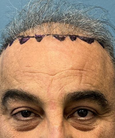 FUE Hair Restoration Before & After Gallery - Patient 108352 - Image 1