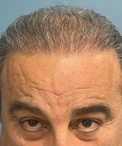 FUE Hair Restoration Before & After Gallery - Patient 108352 - Image 2