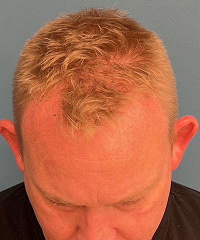 FUE Hair Restoration Before & After Gallery - Patient 599454 - Image 1