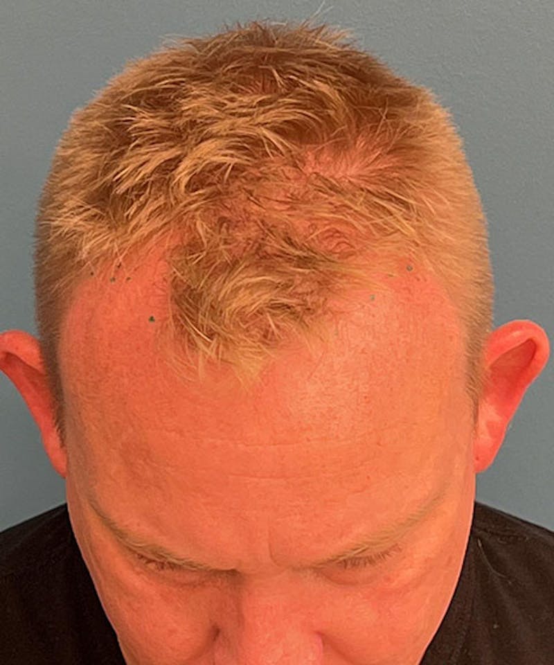 FUE Hair Restoration Before & After Gallery - Patient 599454 - Image 1