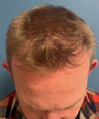 FUE Hair Restoration Before & After Gallery - Patient 599454 - Image 2
