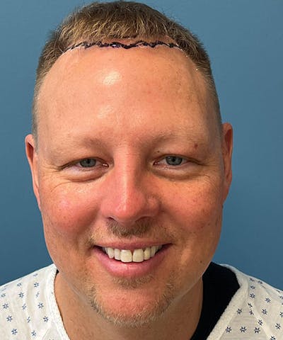 FUE Hair Restoration Before & After Gallery - Patient 723465 - Image 1