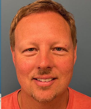 FUE Hair Restoration Before & After Gallery - Patient 723465 - Image 2