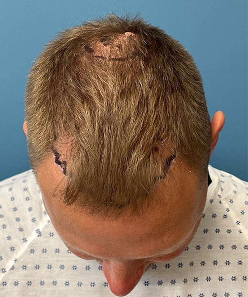 FUE Hair Restoration Before & After Gallery - Patient 723465 - Image 3