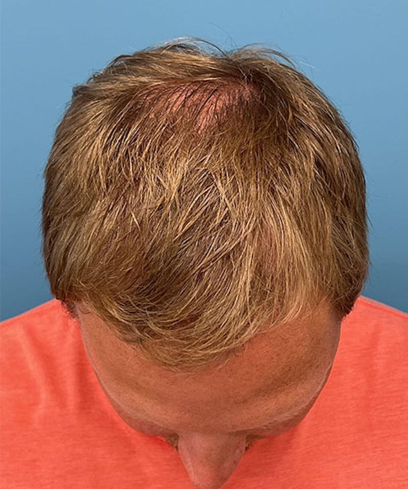 FUE Hair Restoration Before & After Gallery - Patient 723465 - Image 4