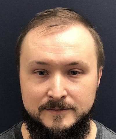 FUE Hair Restoration Before & After Gallery - Patient 220507 - Image 1
