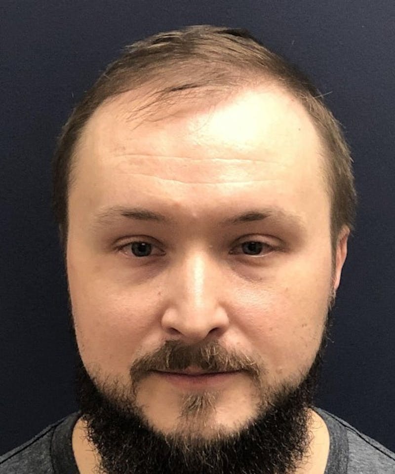 FUE Hair Restoration Before & After Gallery - Patient 220507 - Image 1