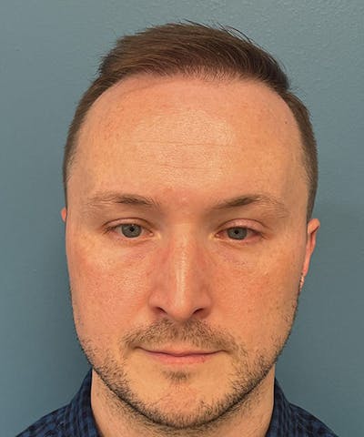 FUE Hair Restoration Before & After Gallery - Patient 220507 - Image 2