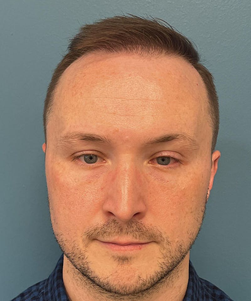 FUE Hair Restoration Before & After Gallery - Patient 220507 - Image 2