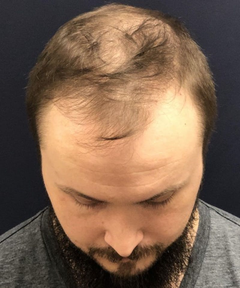 FUE Hair Restoration Before & After Gallery - Patient 220507 - Image 3