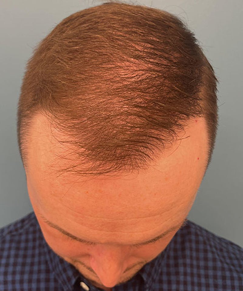 FUE Hair Restoration Before & After Gallery - Patient 220507 - Image 4