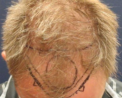 FUE Hair Restoration Before & After Gallery - Patient 329873 - Image 1