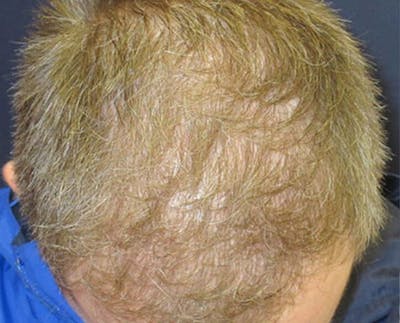 FUE Hair Restoration Before & After Gallery - Patient 329873 - Image 2