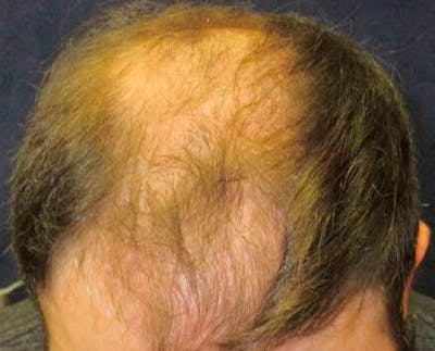FUE Hair Restoration Before & After Gallery - Patient 582964 - Image 1