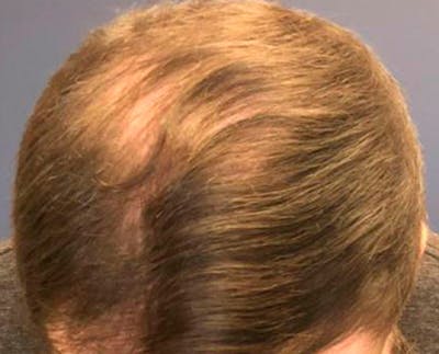 FUE Hair Restoration Before & After Gallery - Patient 582964 - Image 2