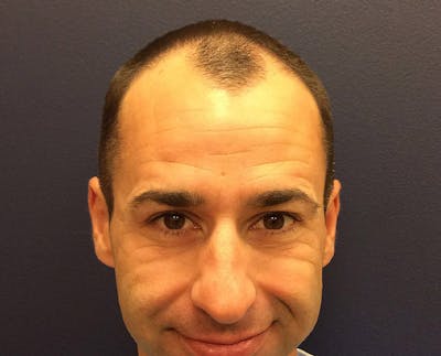 FUE Hair Restoration Before & After Gallery - Patient 354263 - Image 1