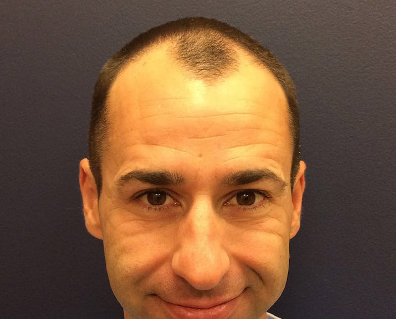 FUE Hair Restoration Before & After Gallery - Patient 354263 - Image 1