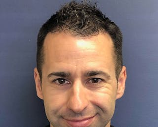 FUE Hair Restoration Before & After Gallery - Patient 354263 - Image 2