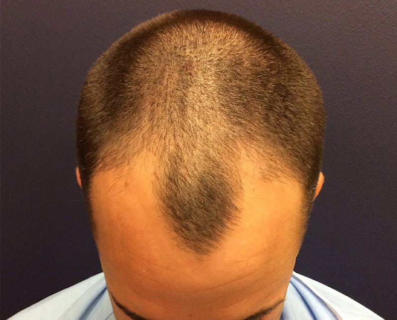 FUE Hair Restoration Before & After Gallery - Patient 354263 - Image 3