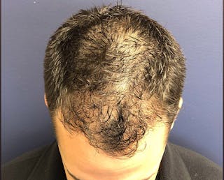 FUE Hair Restoration Before & After Gallery - Patient 354263 - Image 4